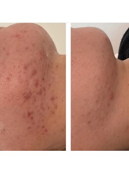 アリュール(Allule)/ニキビケアにも