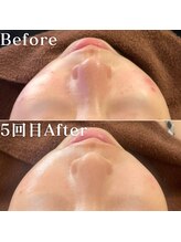 ミニョスキンラボ/韓国式ハーブピーリング5回