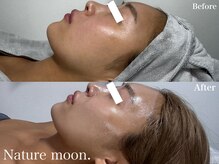 ナチュールムーン(Nature moon.)/ハーブピーリング