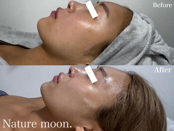 ナチュールムーン(Nature moon.)/ハーブピーリング