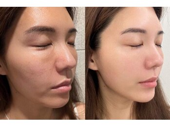 チョンダムビューティー(chondam beauty)の写真/【憧れの韓国女優美肌へ☆】剥離なし◎本気で肌改善したい方必見！韓国発水光肌集中ケア体験♪