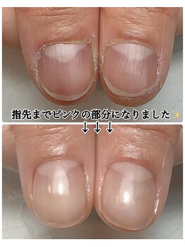 スマイルニコ(smile nico)/親指の成長