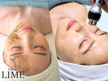 ライム 札幌(LIME)/ハーブピーリング×ラジオ波