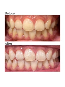 ノーブル 上土店(Noble)/ホワイトニングBeforeAfter