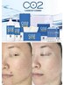【CARBOXY全顔】超高濃度炭酸ガス7万ppm 全顔美肌パック付き　￥6600