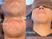 ナーズプラス リベルテ(Naz Plus/Liberte)の雰囲気(大人気/メンズ髭脱毛/地域最安値/男女一律料金)