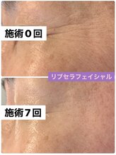 プリュネル(Prunelle)/プラズマシャワー