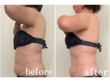 デュモンド(dumonde)/60代1ヶ月での変化