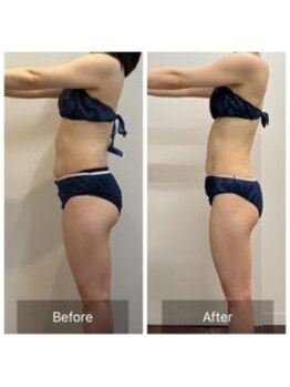 セレア(CELEA)/痩身ダイエット/セル脂肪撃退