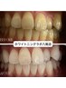 【通い放題】セルフホワイトニング月々¥8500(8カ月継続コース)