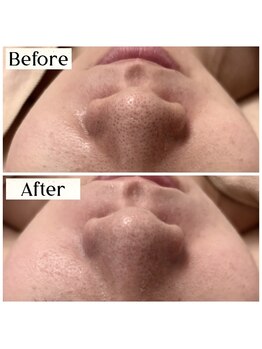 ルアナ 柏店(LUANA)/黒ずみ毛穴改善例