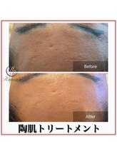 ラナン パラフューズ(Ranun's PARAFUSE.)/陶肌ビフォーアフター（6）