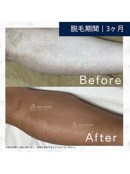 メンズクリア 福山駅前店/【メンズクリア】お客様の施術例