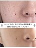 【毛穴悩みにおすすめ★】ヘッド45分×毛穴洗浄×最新美容液導入で陶器肌♪