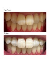 ノーブル 上土店(Noble)/ホワイトニングBeforeAfter