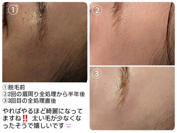 ベビースキン(baby skin)/美容電気脱毛