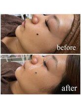 ミラ 中央林間(mira)/小顔　毛穴　ホワイトニング