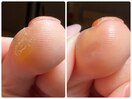 指の頑固なタコもすっきり綺麗に