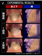 RBL 仙台店/メンズ脱毛/ヒゲ脱毛施術2回目