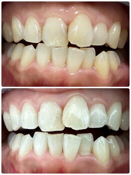 グラスプレイス/プレミアム症例 4