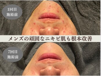 ミソル(misolle.)/メンズのニキビケアも得意です!