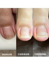 リリ(lili)/巻き爪矯正（～2回目施術後）