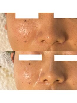 ココ(COCO)/ハーブピーリング/REVI/高知