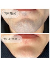 アウラ(AURA)/青ひげがなくなりました♪