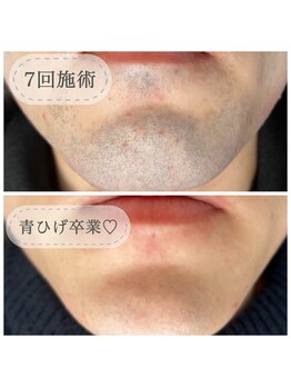 アウラ(AURA)/青ひげがなくなりました♪