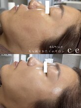 シャルム エスボーテ(charme Esbeaute)/スキンケア併用でご使用の経過