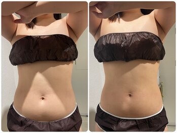 イデアルミー 大宮店(イデアルMe)/３回目施術でウエスト－2.5cm！