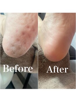 クリム(Culim)/角質ケアBefore→After