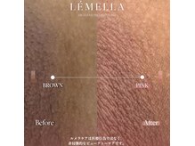 ルミナス ケア(Luminous Care)の雰囲気（ルメラ/外陰部・Before/After）