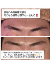 ベビースキン(baby skin)/美容電気脱毛