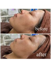 ミラ 中央林間(mira)/小顔　毛穴　ホワイトニング