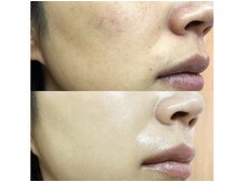 《リピートNo.1》IPL美肌光フォト