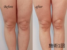 フルーブラン(Frubran)/【慢性疲労に】アロママッサージ