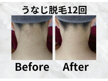 アネラ(anela)/うなじ脱毛で後ろ姿美人に♪