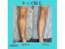 アクト クロ(ACT curro)/【キッズ】脱毛施術例