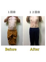 マリモ鍼灸接骨院/電磁パルス週1回12回目