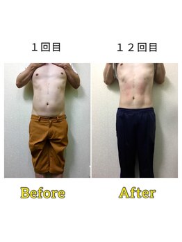 マリモ鍼灸接骨院/電磁パルス週1回12回目