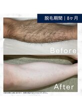 メンズクリア 福山駅前店/【メンズクリア】お客様の施術例