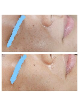 エターナル(Eternal)/ララピール×LDM×エクソソーム