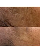 ウィンウィン 新山口店(Win Win)/シミにアプローチ