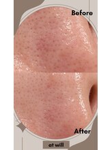 アットウィル 志木店(at will)/毛穴洗浄BeforeAfter