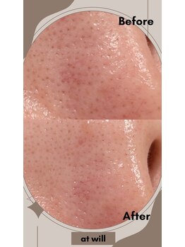 アットウィル 志木店(at will)/毛穴洗浄BeforeAfter