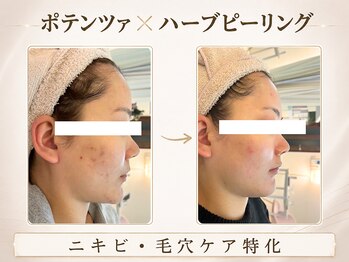 リノ ショウナン(LINO SHONAN)/before→after