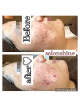 サロンシャイン(Salon Shine)/ハーバルピールレベル7