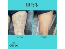 アクト クロ(ACT curro)/【脚全体】脱毛施術例
