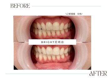 ホワイトニングサロンブライト 尼崎店(Whitening salon bright)/夏本番歯で笑顔もアップ↑↑